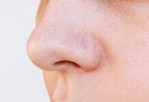 Jak sobie poradzić z rozszerzonymi porami?